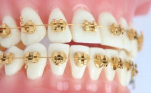 Dental palmar ortodoncia_!