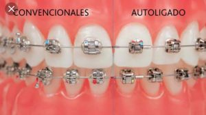 Dental palmar ortodoncia_13