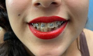 Dental palmar ortodoncia_2