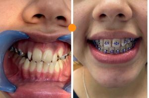 Dental palmar ortodoncia_3