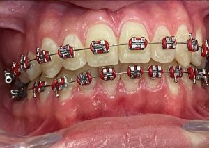 Dental palmar ortodoncia_4