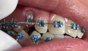 Dental palmar ortodoncia_5