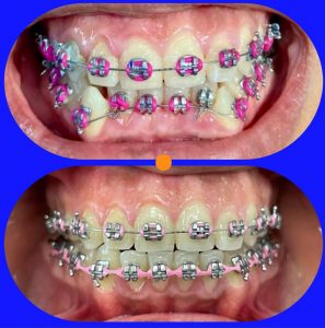 Dental palmar ortodoncia_8